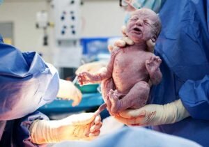 Bebê retirado do útero por parto de cesárea na sala cirúrgica