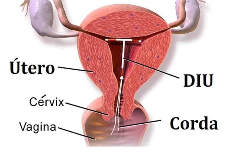 Ilustração de um Diu inserido dentro do útero