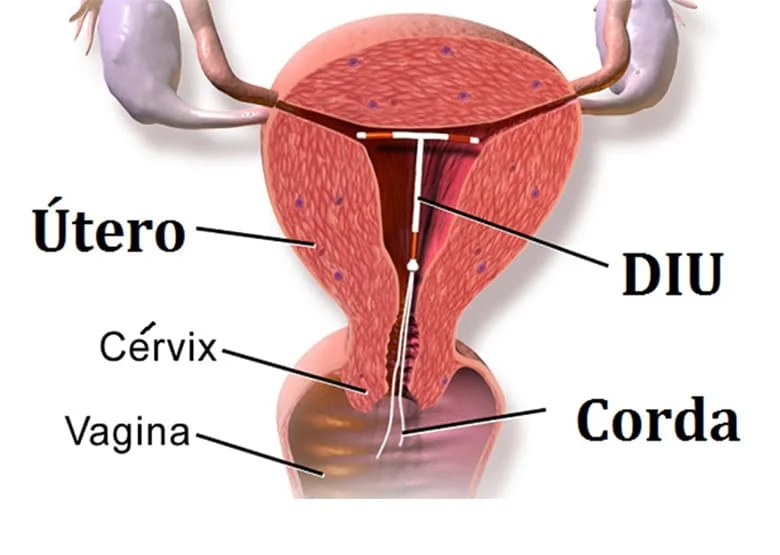 4 Tipos de DIU, Qual é o Melhor e Como Escolher o Certo!