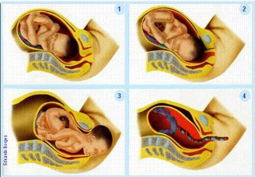 Ilustração de bebê em posição de parto dentro da barriga de uma gestante durante a fase de dilatação expulsiva